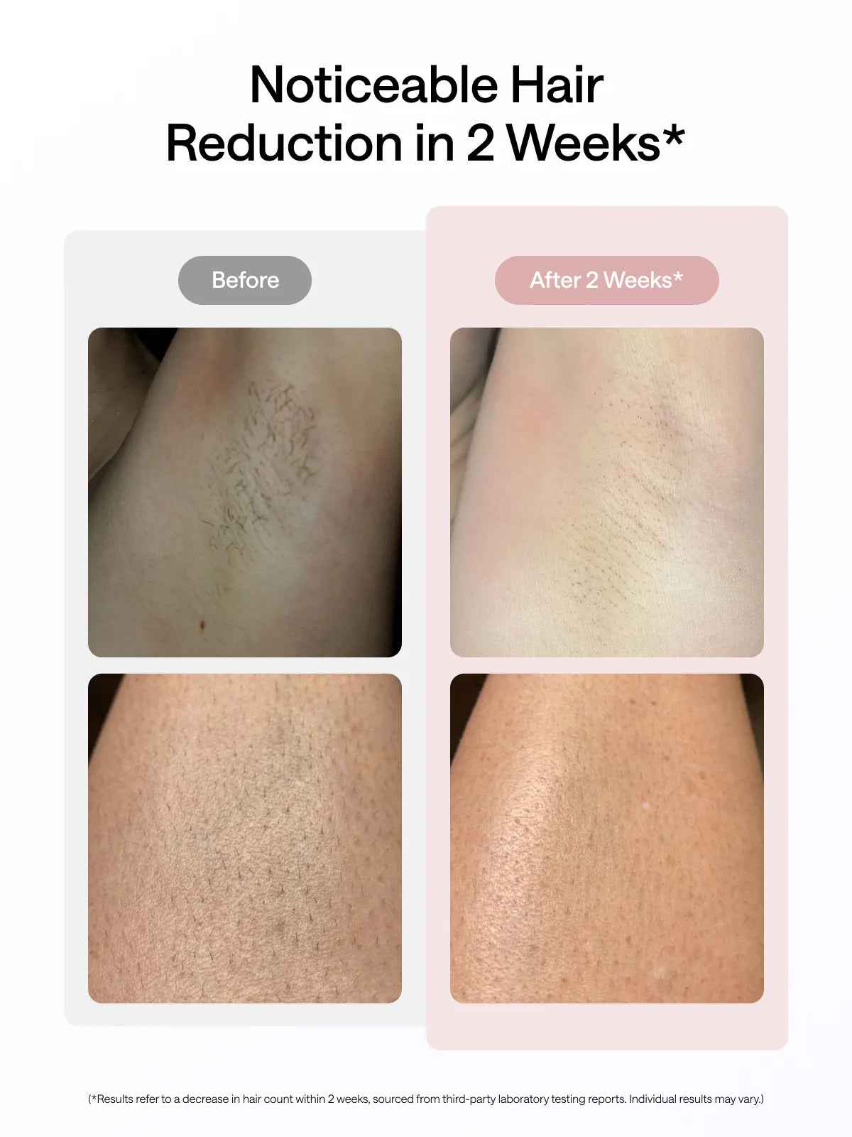 Air 10 Next-Gen IPL Hair Removal | FDA-Cleared for Results in 2 Weeks - Essence Bleu