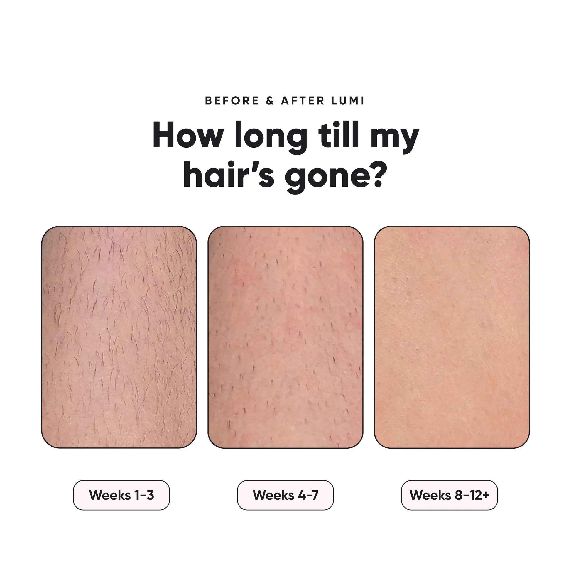 Lumi - Permanent Hair Removal Device - Essence Bleu